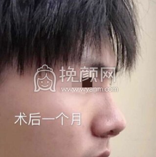 深圳李信锋鼻整形医院李信锋医生做的*