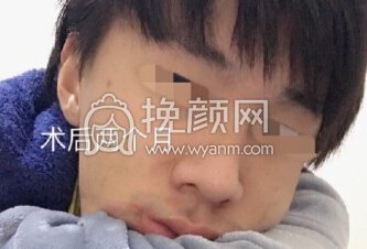 深圳李信锋鼻整形医院李信锋医生做的*