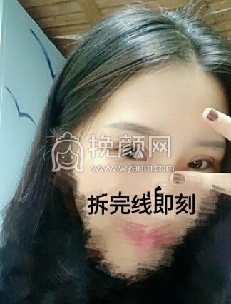 浙江金华比丽芙医院夏崇明全切开眼角+提肌