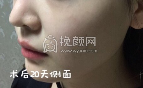 长沙伊美整形唐中华医生做的面部吸脂