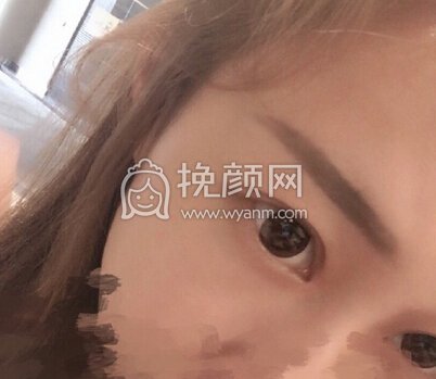 重庆五洲女子医院范文亮做的全切+开眼角