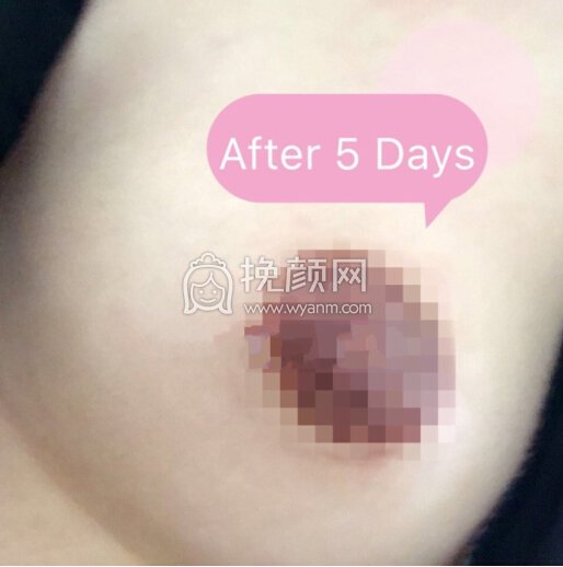 上海光博s医院乳晕激光嫩红