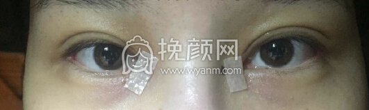 嘉兴曙光医院高院长做的双眼皮加内外眼角