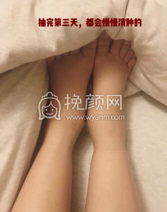 北京八大处东院王春虎医生大小腿环吸