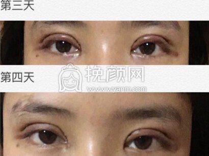 华西西藏成办郭祥文双眼皮不连眼头+开眼角