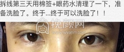 华西西藏成办郭祥文双眼皮不连眼头+开眼角