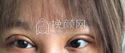 杭州整形医院国际部蹇洪双眼皮+内眼角+提肌