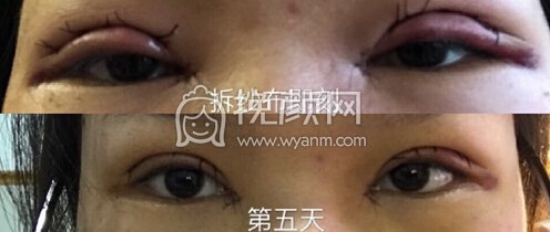 上海九院李茅医生全切抽脂双眼皮+开眼角