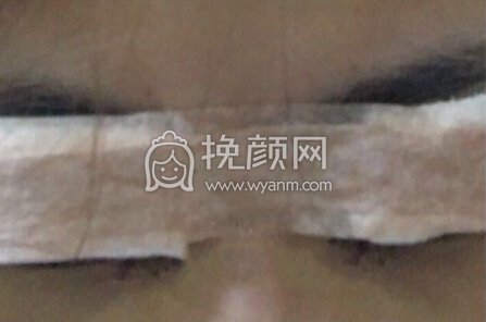 厦门第一医院殷佳鹏全切双眼皮加开眼角