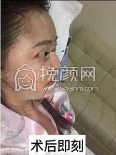 武汉美立方美容医院胡文亚脂肪填充和下巴修复