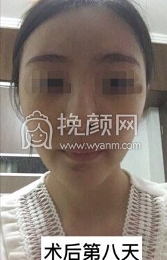 武汉美立方美容医院胡文亚脂肪填充和下巴修复