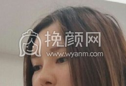 大连新华美天整形王大太鼻子修复和双眼皮开眼