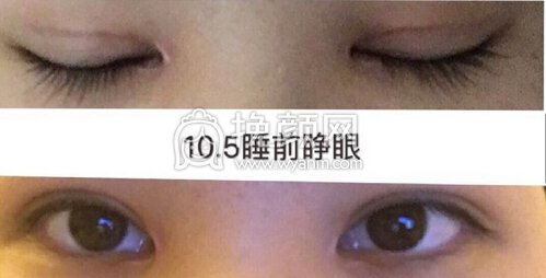 深圳美莱梁院长梁晓健做的提肌+内眼角