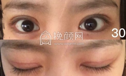 济南美莱整形医院韩旭院长全切双眼皮+开内眦