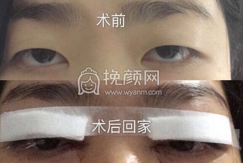 成都华美紫馨艾剑英双眼皮+提肌+内眼角