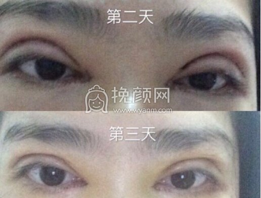 成都华美紫馨艾剑英双眼皮+提肌+内眼角