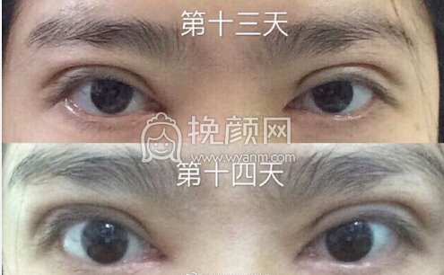 成都华美紫馨艾剑英双眼皮+提肌+内眼角