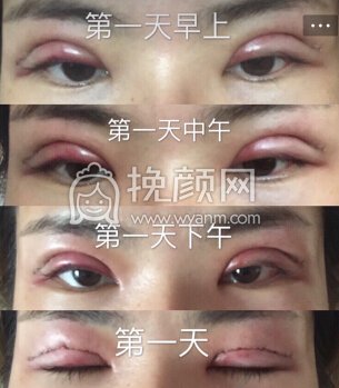 长沙申美肿泡眼去皮去脂全切