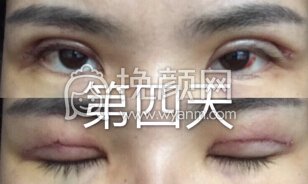 长沙申美肿泡眼去皮去脂全切