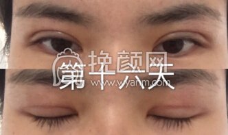 长沙申美肿泡眼去皮去脂全切