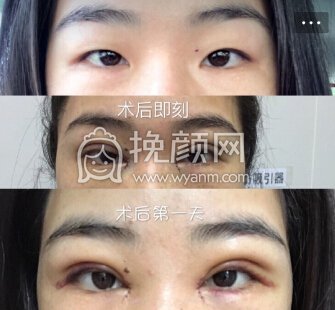 中山市如花整形美容门诊霍旺佳*加开眼角