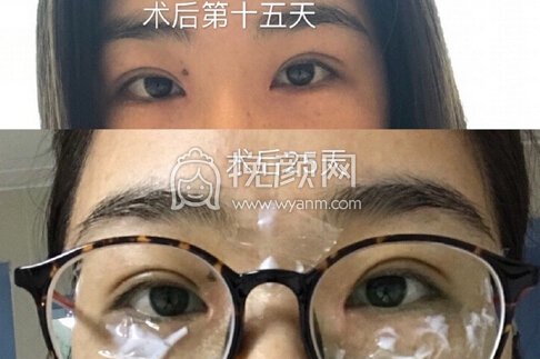 中山市如花整形美容门诊霍旺佳*加开眼角