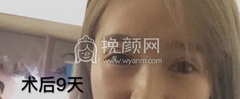 重庆华美何春涛医生做的双眼皮+内眼角