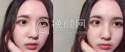 上海九院谢芸医生做的双眼皮全切+开眼角+左眼提