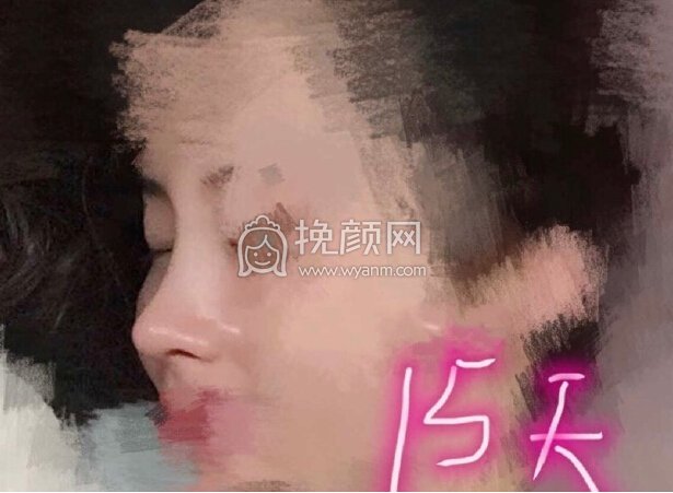 大连李荣喆医生做的自体肋软骨隆鼻