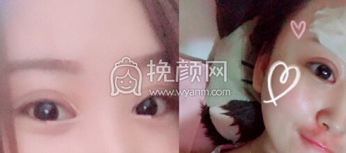 北京八大处王永前医生做的双眼皮+开眼角+面吸