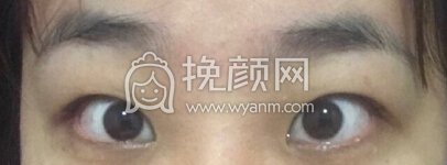 福州优医联合王立敏重睑+去皮去脂＋开眼角