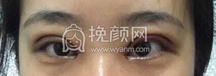 福州优医联合王立敏重睑+去皮去脂＋开眼角