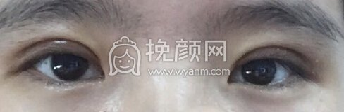 厦门中医院卢艺朴医生全切双眼皮+抽脂