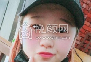 武汉美丽尔整形医院李展平全切双眼皮开内眼角