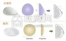 假体丰胸材料要多少钱