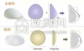 假体隆胸假体取出*吗