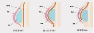 隆胸假体怎么正确选择