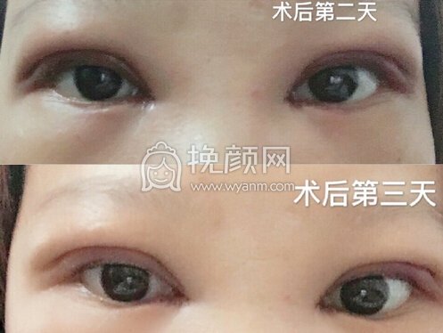 广州美莱美容田跃平全切+开眼角+上脸下垂