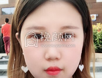 广州美莱美容田跃平全切+开眼角+上脸下垂