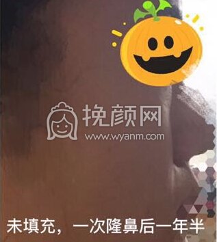 八大处平安里诊所杨欣面颊填充，硅胶修复