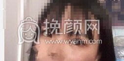 武汉艺星朱胜军院长做的精切+开眼角