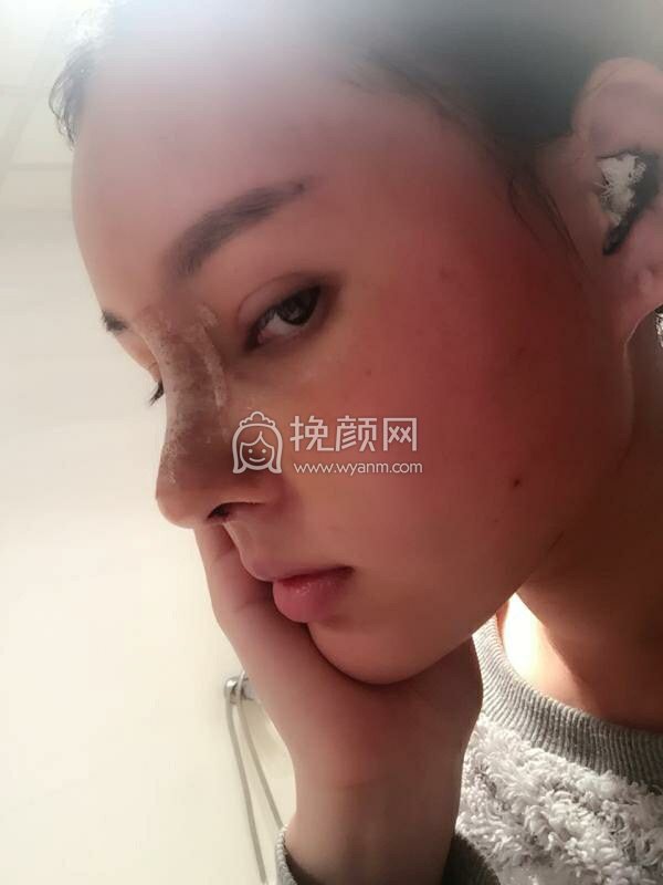 沈阳盛京尚美王超隆鼻怎么样？案例