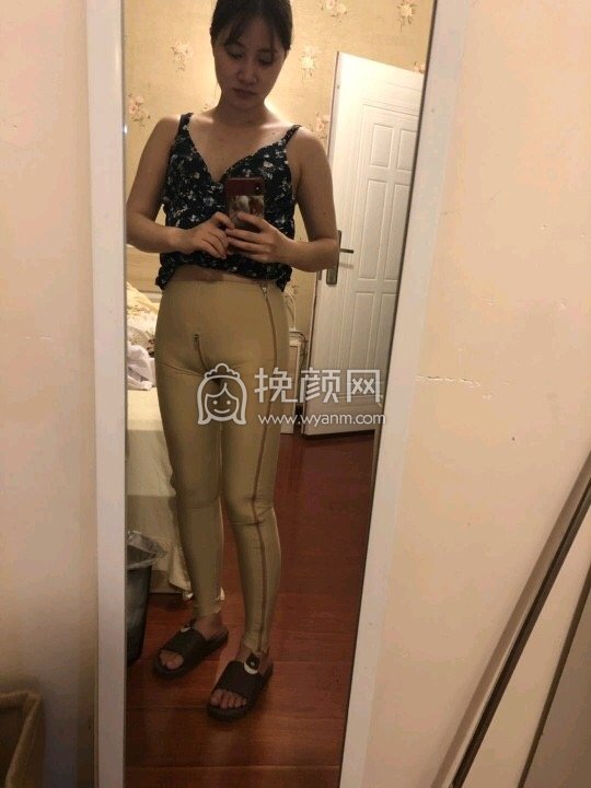 南京美莱整形夏建军大腿吸脂好吗？案例