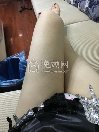 兰州华美冯晓明大腿吸脂怎么样?案例