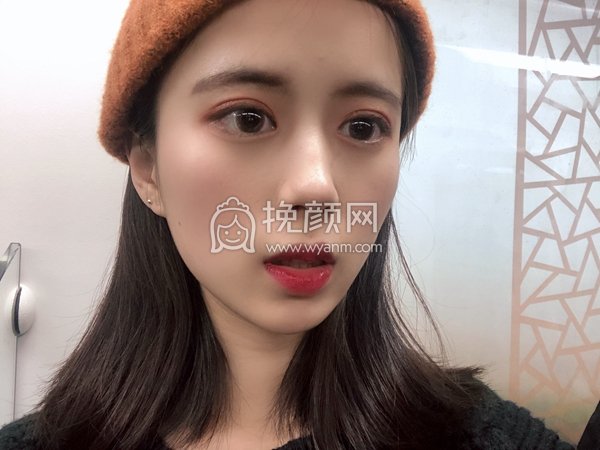 杭州美莱医疗李波隆鼻有案例吗？分享