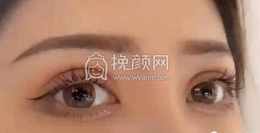 双眼皮系列干货|术后注意事项+护理方法