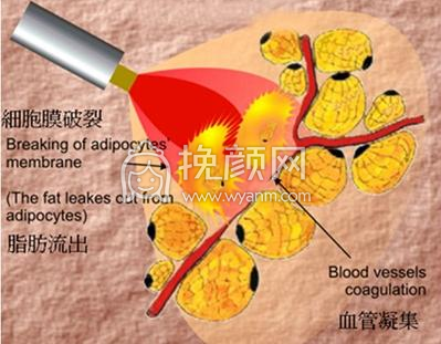 广州吸脂黄皓、杨德发、王世虎哪个医生技术好