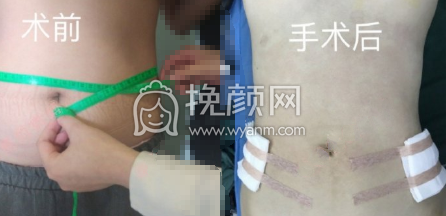 长沙梵童陈仕文多维水溶腰腹大腿吸脂案例|*果