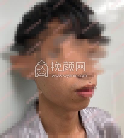 成都美熹医院刘家亘硅胶垫下巴案例|*果|价格