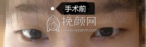 石家庄馨悦张卓男全切双眼皮手术案例|*果|价格